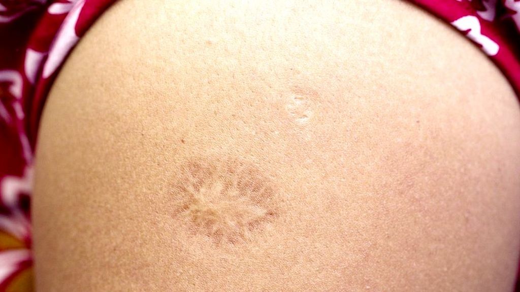 What Did The Smallpox Vaccine Scar Look Like